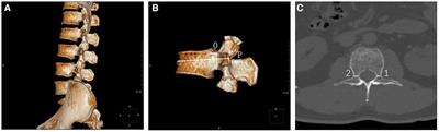 3D-CT reconstruction for pedicle outer width assessment in patients with thoracolumbar spine fractures: a comparative analysis between age groups <60 years and ≥60 years